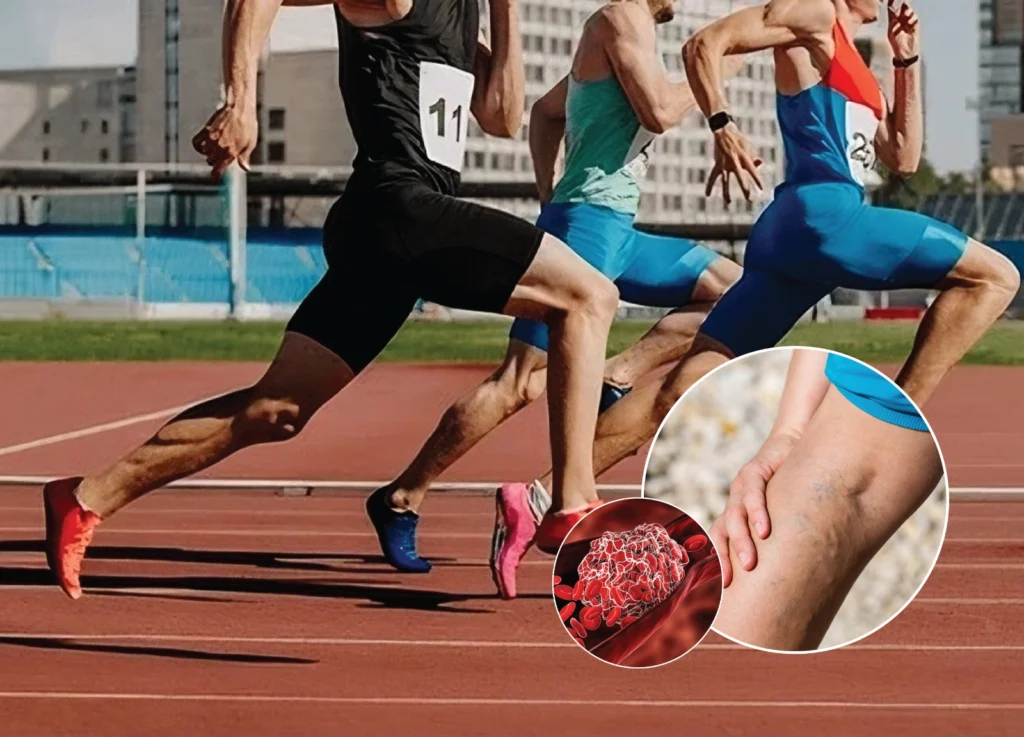 Understanding and Managing Varicose Veins