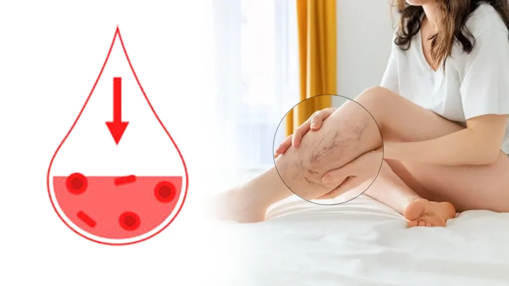 Understanding and Managing Varicose Vein