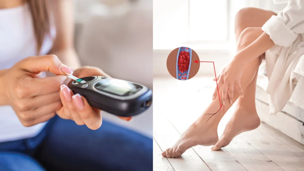 Understanding and Managing Varicose Vein