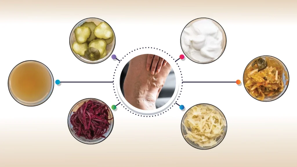 Understanding and Managing Varicose Vein