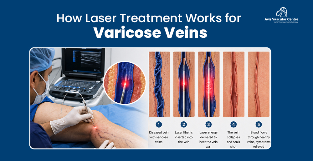 How Laser Treatment Works for Varicose Veins