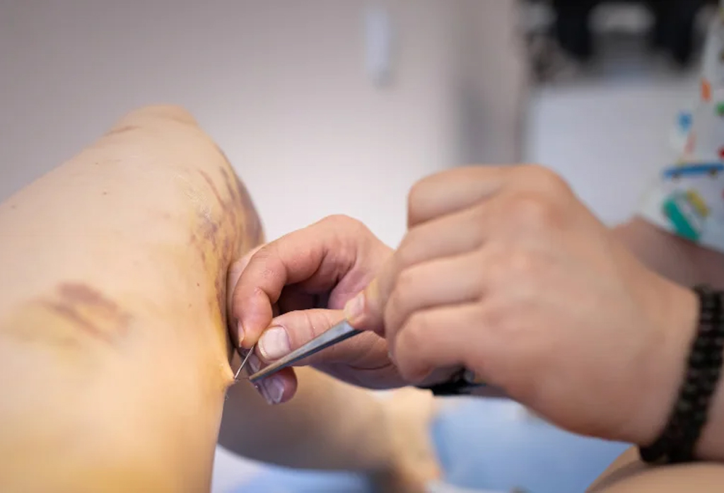 Doctor performing RFA procedure