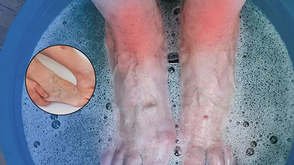 Understanding and Managing Varicose Vein