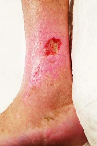 Illustration of Varicose Veins