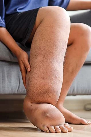 Varicose Veins Leg