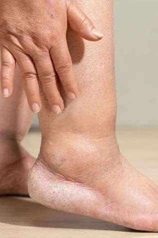 Illustration of Varicose Veins