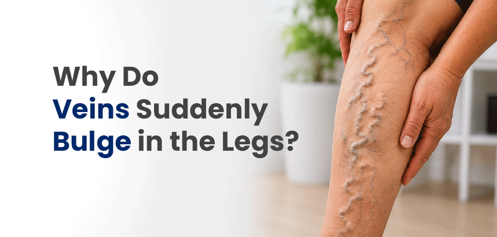 Understanding and Managing Varicose Veins