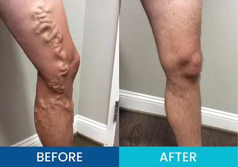 Varicose Veins