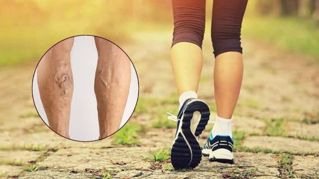 Walking and Varicose Veins