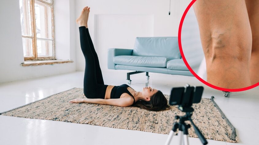 elevating legs for varicose veins